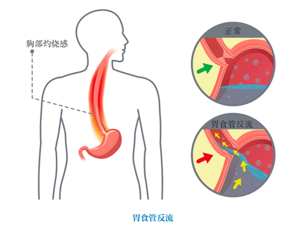 “吃出来”的癌症！喉咙出现这4种症状 就要小心了