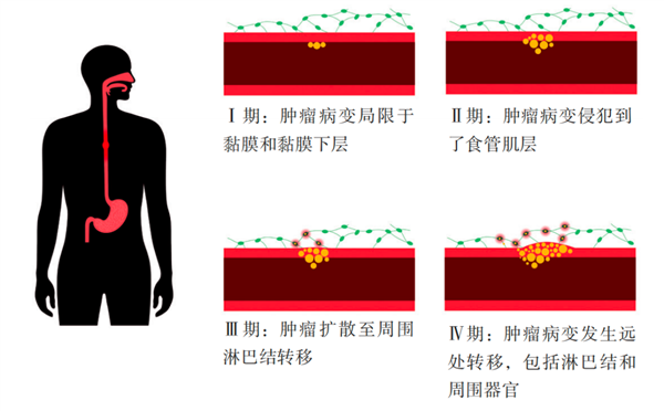 “吃出来”的癌症！喉咙出现这4种症状 就要小心了